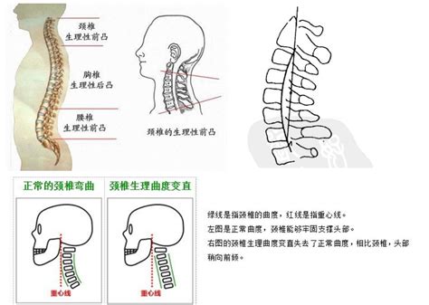 反弓|颈椎反弓怎么办？